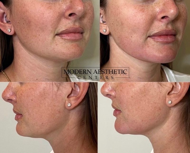 Dermal Fillers Gallery Before & After Image