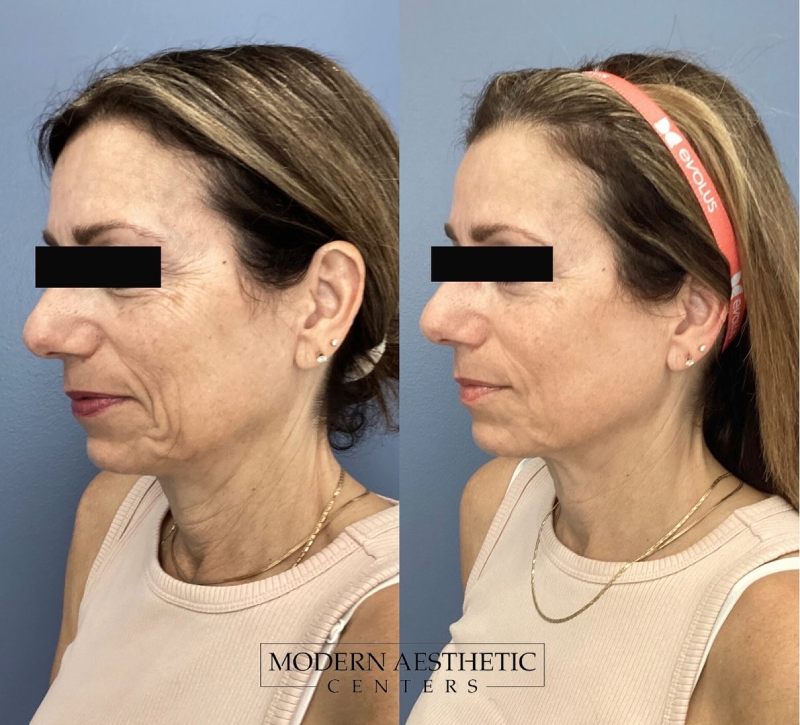 Dermal Fillers Gallery Before & After Image