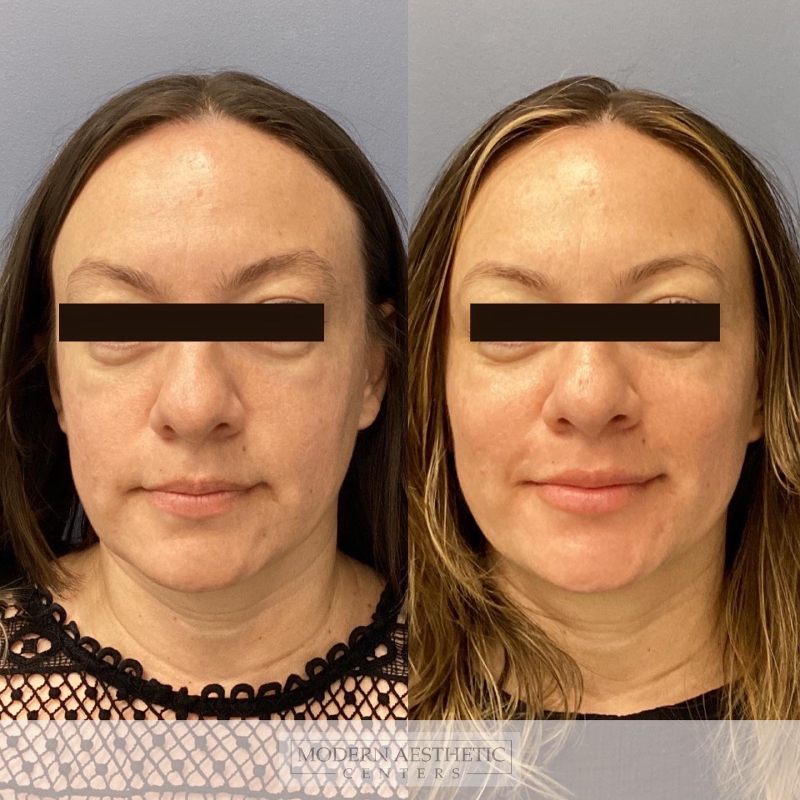 Dermal Fillers Gallery Before & After Image