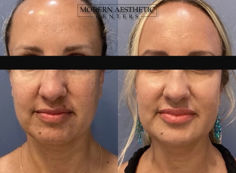 Dermal Fillers Gallery Before & After Image