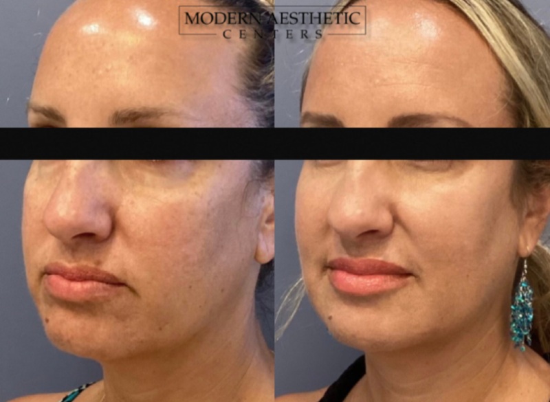 Dermal Fillers Gallery Before & After Image