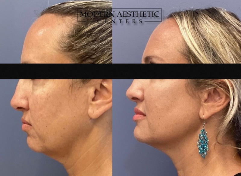 Dermal Fillers Gallery Before & After Image
