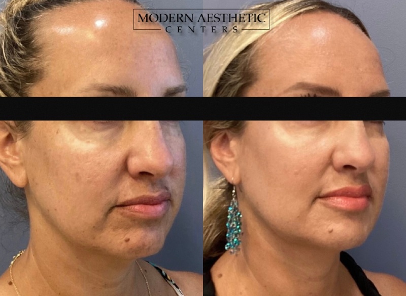 Dermal Fillers Gallery Before & After Image