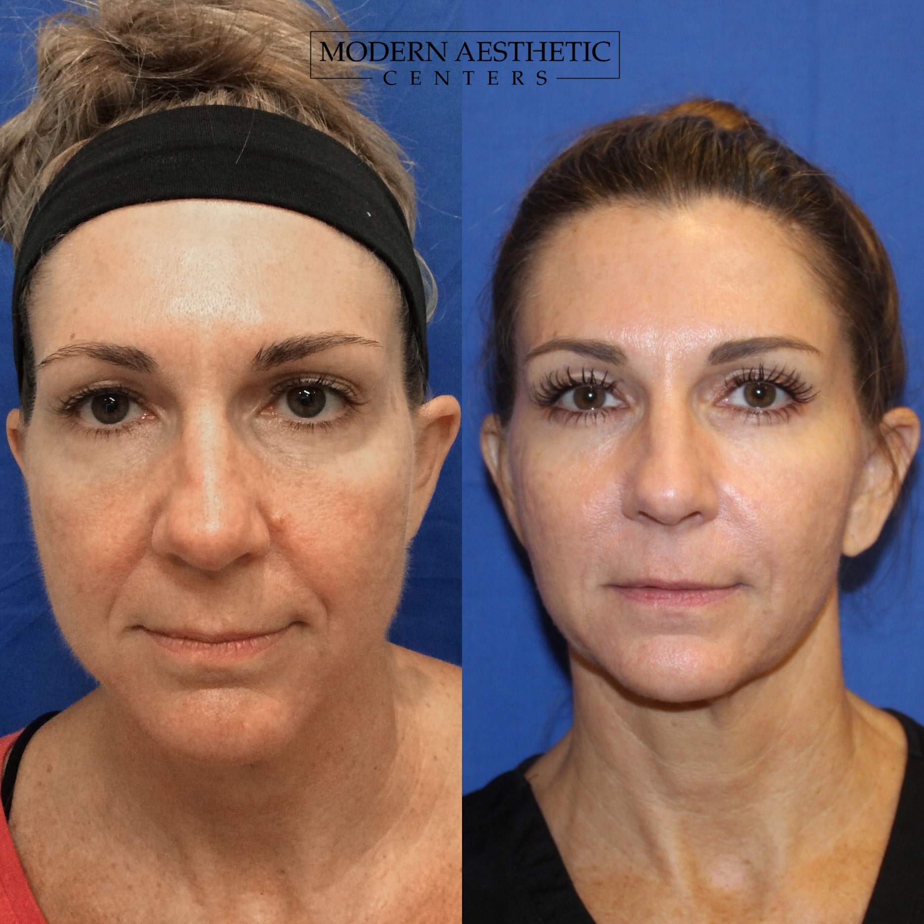 Dermal Fillers Gallery Before & After Image