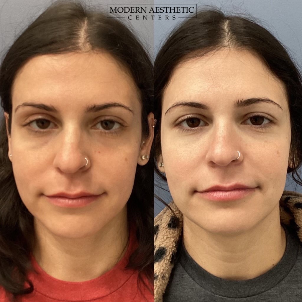 Dermal Fillers Gallery Before & After Image