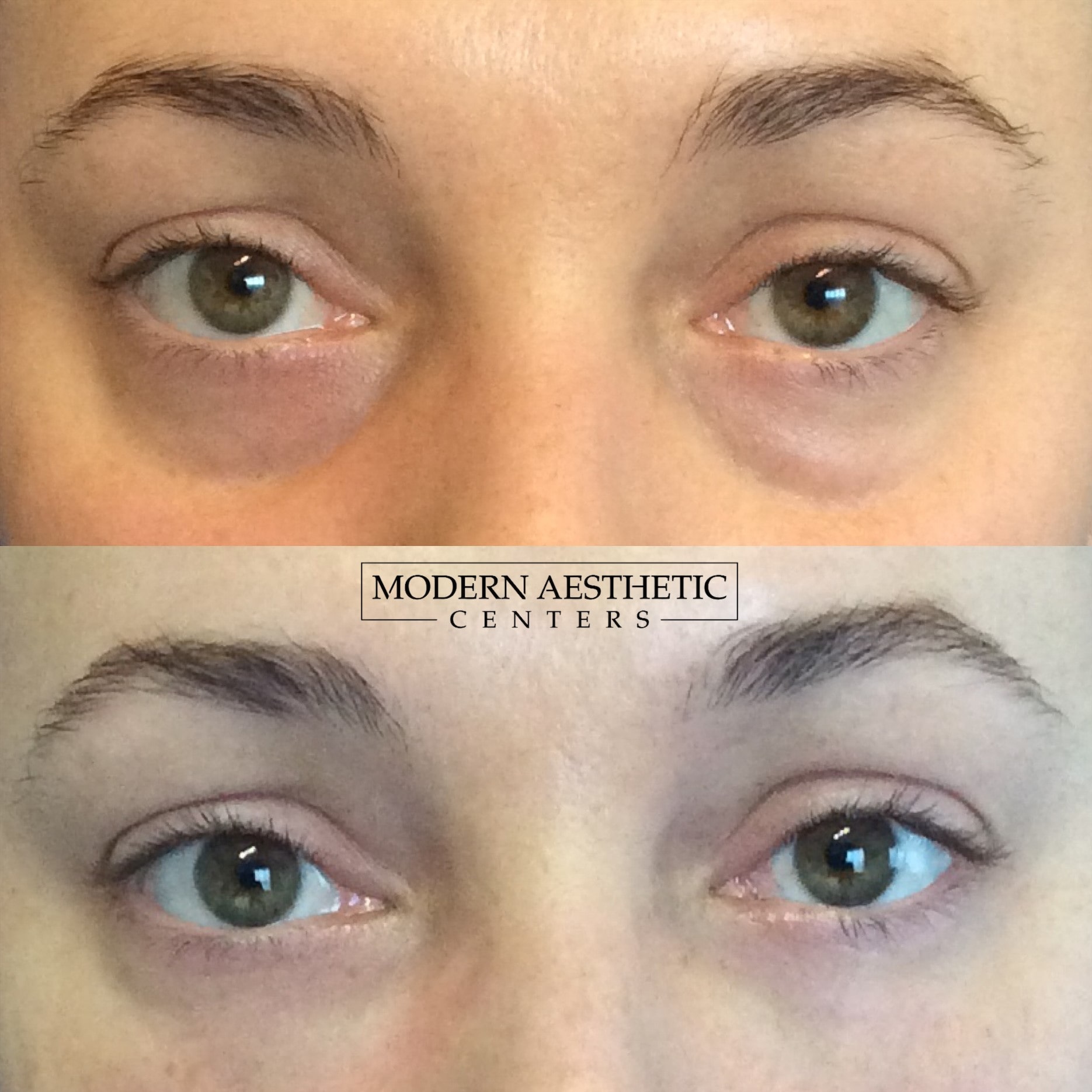 Dermal Fillers Gallery Before & After Image