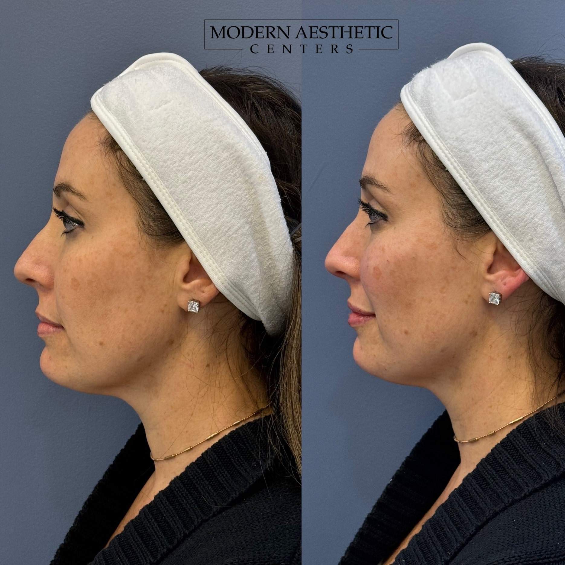 Dermal Fillers Gallery Before & After Image