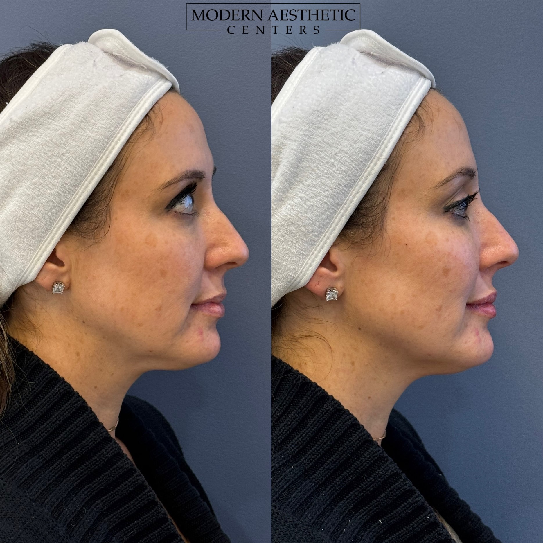 Dermal Fillers Gallery Before & After Image