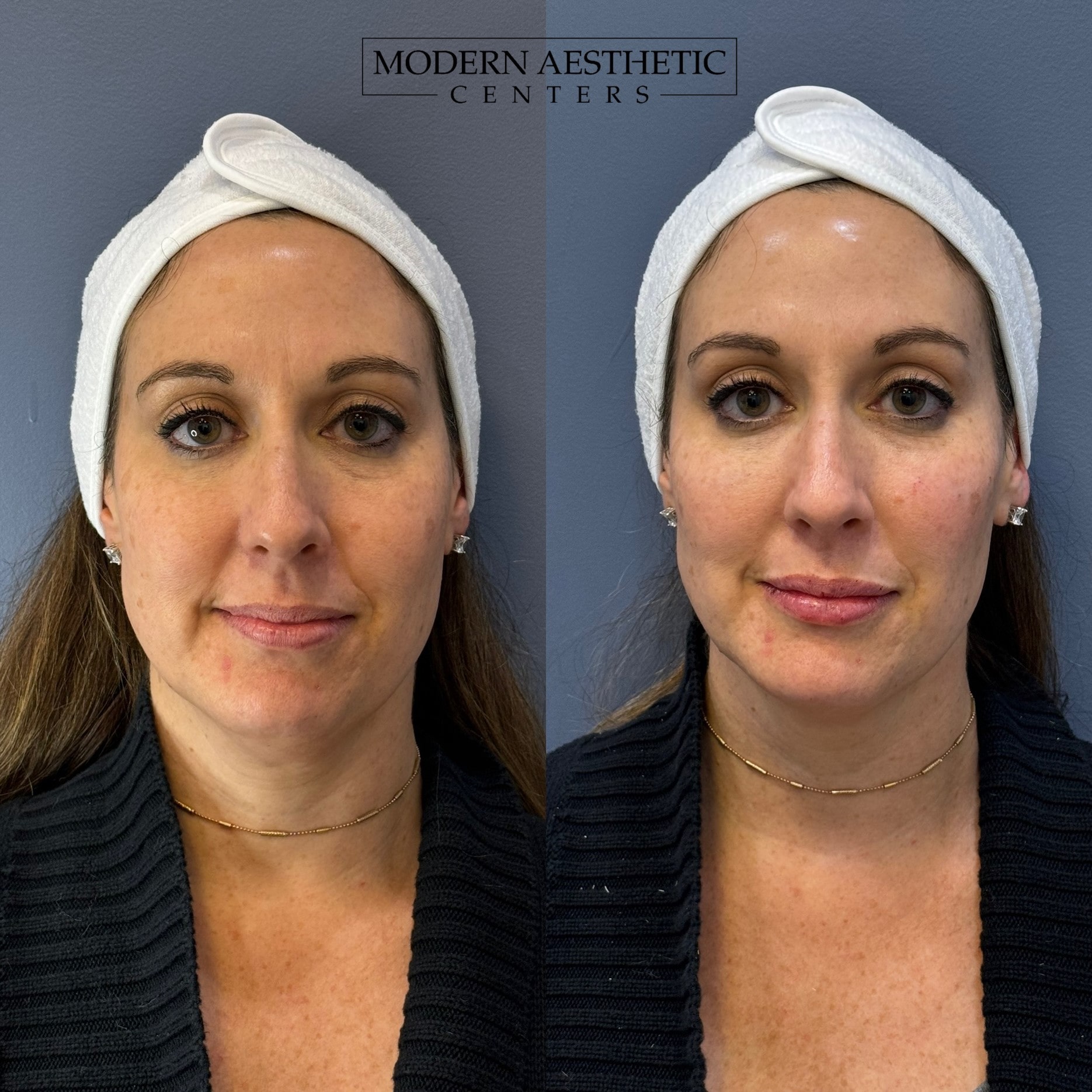 Dermal Fillers Gallery Before & After Image