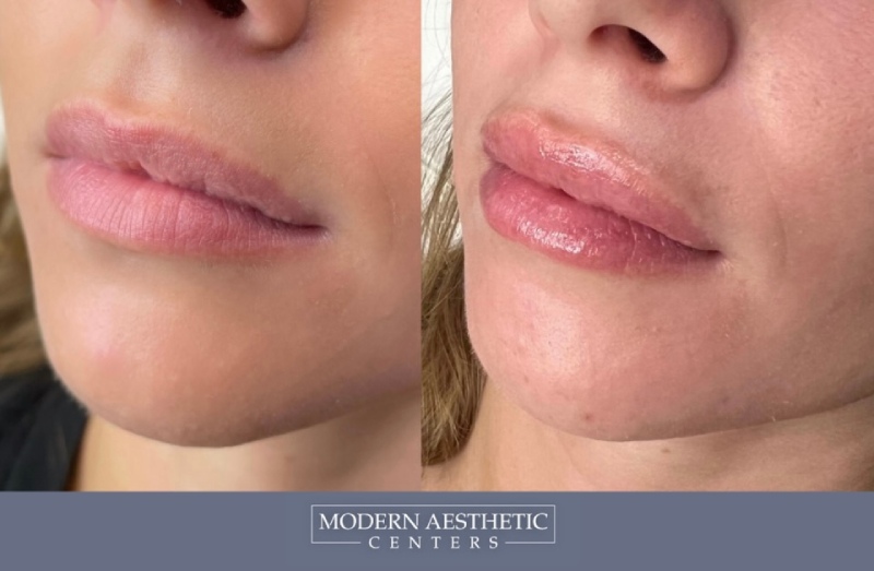 Lip Fillers Gallery Before & After Image