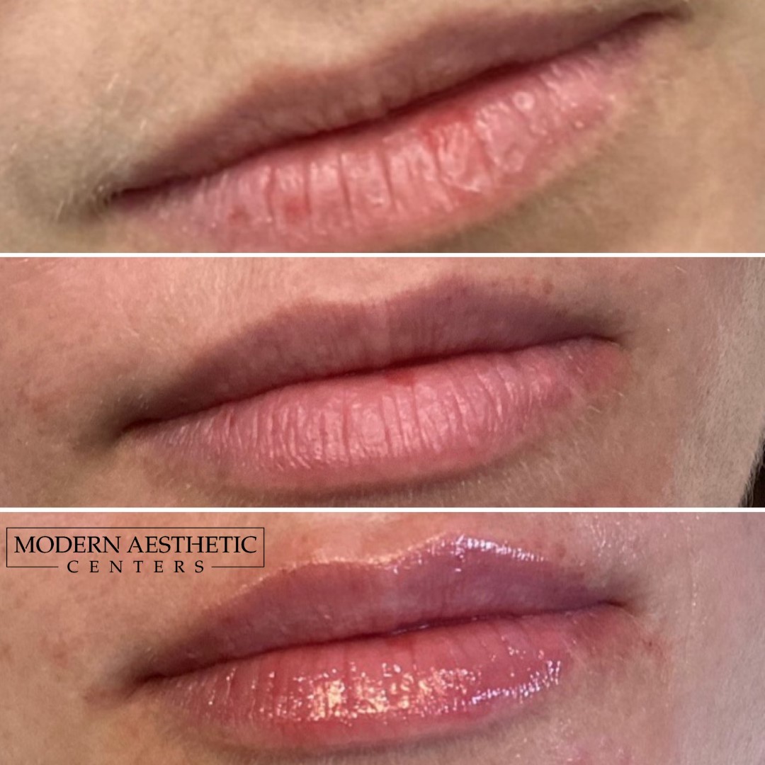 Lip Fillers Gallery Before & After Image