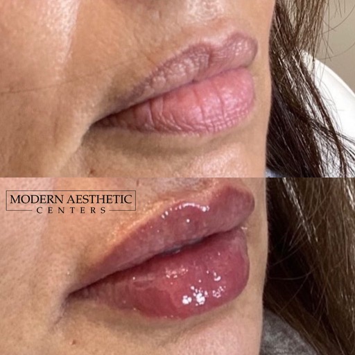 Lip Fillers Gallery Before & After Image