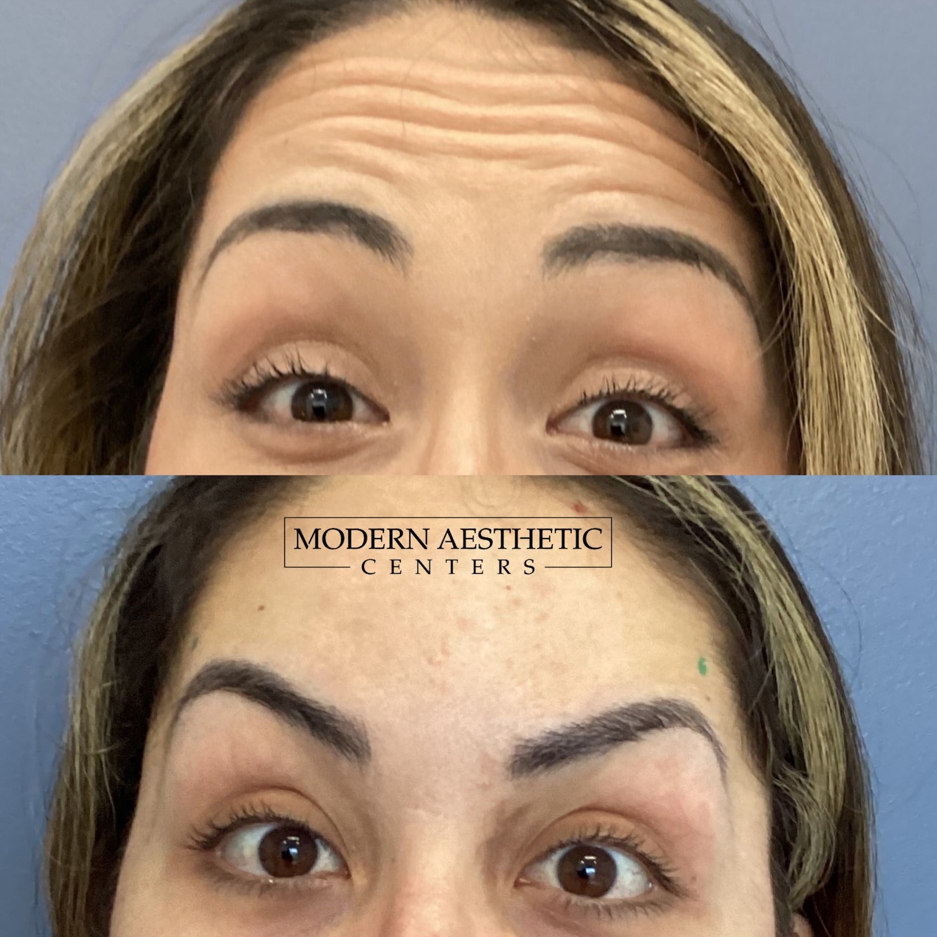 Wrinkle Relaxers Gallery Before & After Image