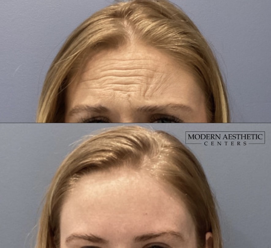 Wrinkle Relaxers Gallery Before & After Image