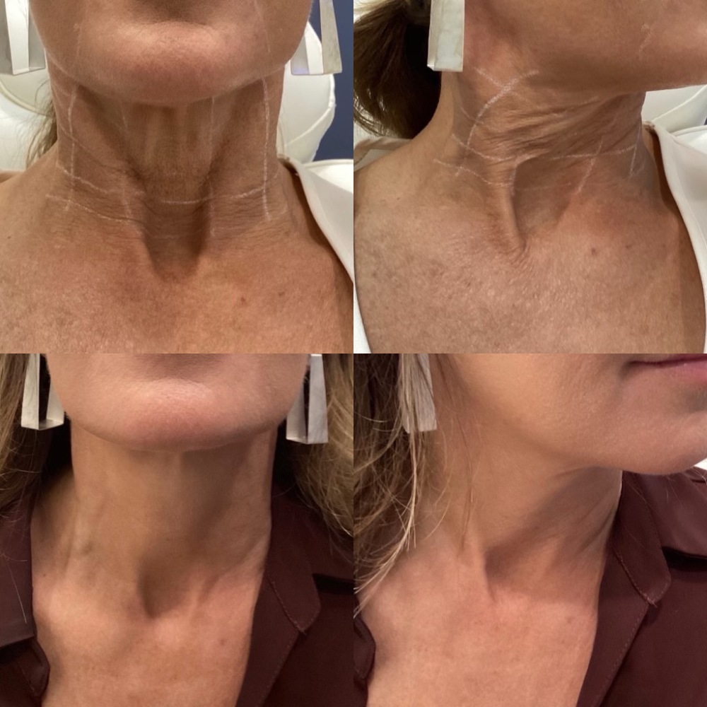 Wrinkle Relaxers Gallery Before & After Image