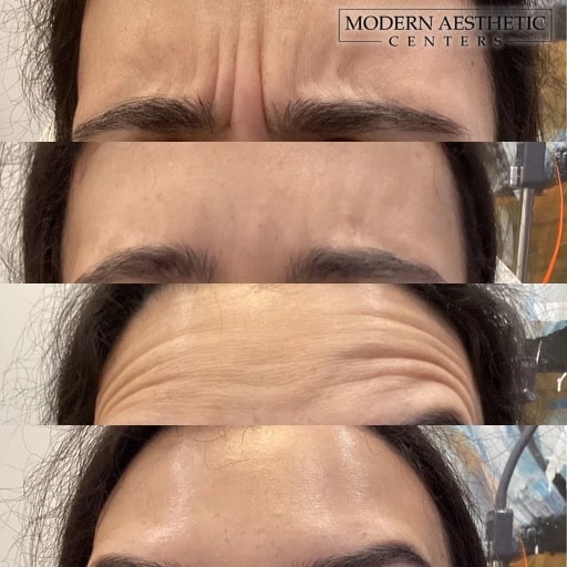 Wrinkle Relaxers Gallery Before & After Image