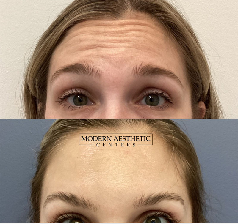 Wrinkle Relaxers Gallery Before & After Image